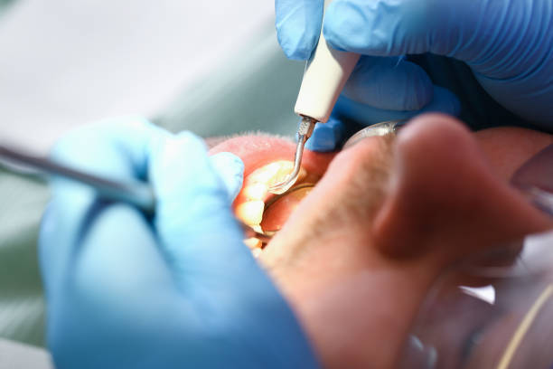 Best Emergency Treatment for Dental Infections or Abscesses in Chattahoochee Hills, GA